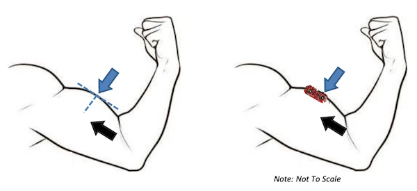 Capteur myo-électrique